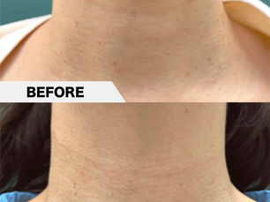 Lateral neck wrinkles, PRPF®︎ injection therapy