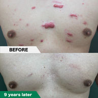 Scar contracture plasty (excision of true keloids, Z-plasty, 5-flap - repair with a combined design of multiple skin valves)