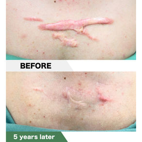Anterior chest keloid