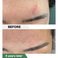 Scar Above the Eyebrow