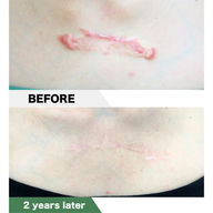 Anterior Chest Keloid