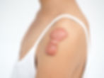keloid ケロイド