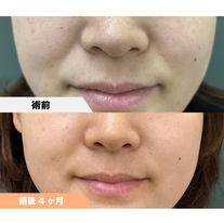 ほうれい線 PRPF®︎注入療法