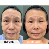 Lower eyelid groove under eyes, PRPF®︎ injection therapy