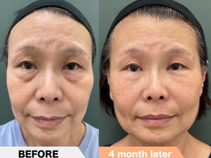 Lower eyelid groove under eyes, PRPF®︎ injection therapy