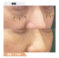 目の下のクマ PRPF®︎注入療法