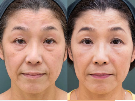 Lower eyelid groove under eyes, Smile lines, PRPF injection therapy