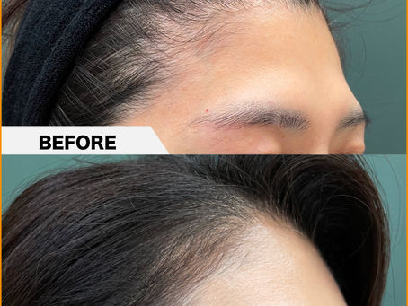 Forehead,PRPF Therapy Injection