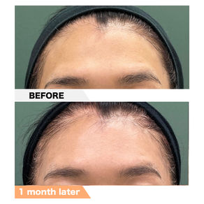 Forehead, PRPF Injection Therapy