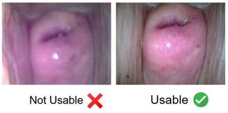 AI tools can distinguish between blurry (left) and clear (right) images, helping providers capture interpretable images and improving consistency for AI-assisted diagnosis.