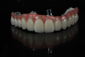 Prothèse dentaire complète, fixée sur implants