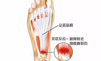 plantar facistis 2.jpeg