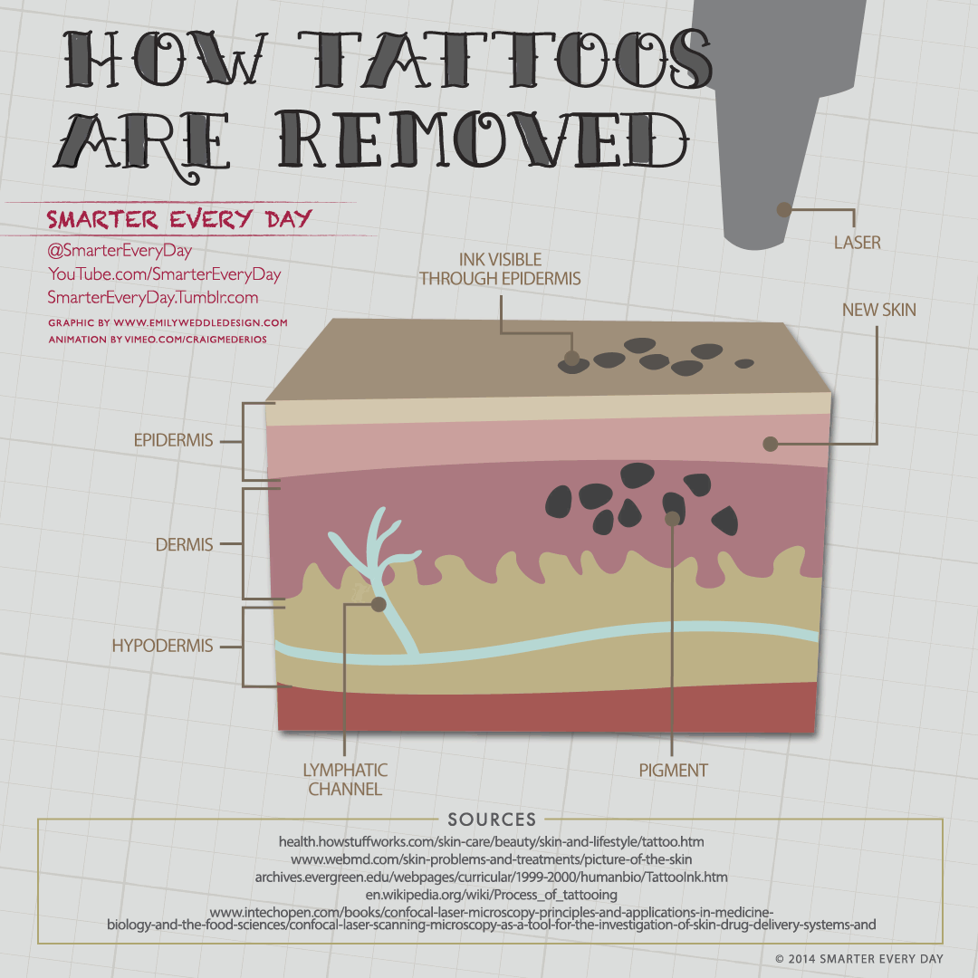 Picosure Tattoo Removal North Myrtle Beach SC Review RealSelf #65 Picosure Tattoo Removal North Myrtle Beach SC Review RealSelf