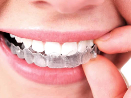 TUDO SOBRE O INVISALIGN: O QUE É, HISTÓRIA, APLICAÇÕES, PREÇO, PROCEDIMENTO