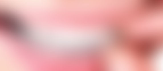 TUDO SOBRE O INVISALIGN: O QUE É, HISTÓRIA, APLICAÇÕES, PREÇO, PROCEDIMENTO