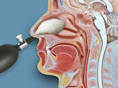 NRT image ballooning.jpg