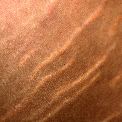 STRETCH MARKS: HOW TO GET RID OF THEM