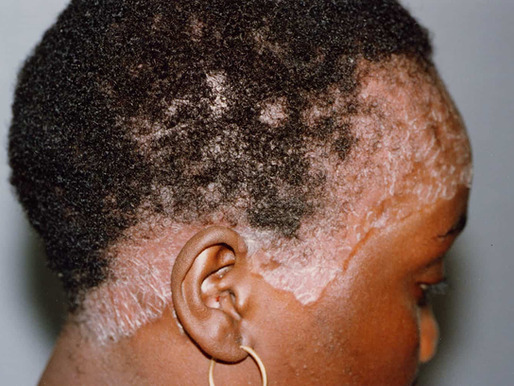 Overcoming Psoriasis.