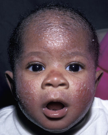 ECZEMA