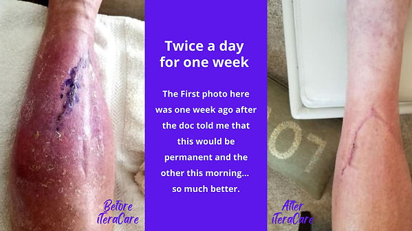 The iTeraCare Wand is great for speeding up the healing process