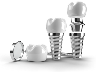 Composite Bonding