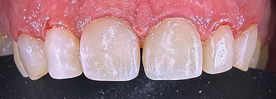 Uprava zubov pomocou metodou direct tooth bonding