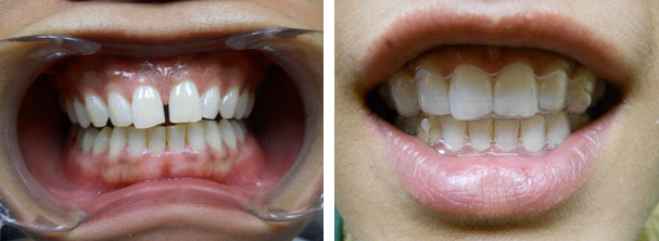 totaldentalcare_invisalign_02