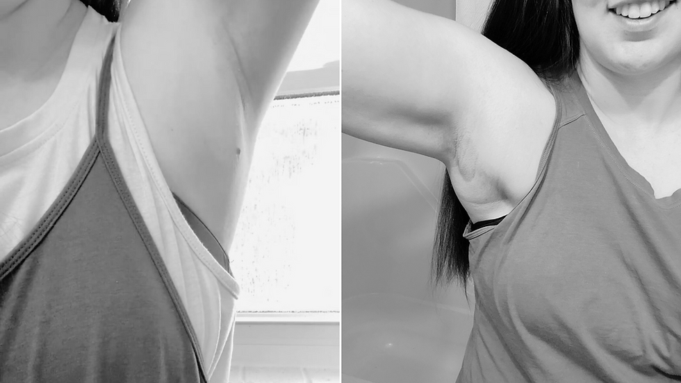 6 months - all puff to some pit starting to show in my armpits from lymphatic drainage
