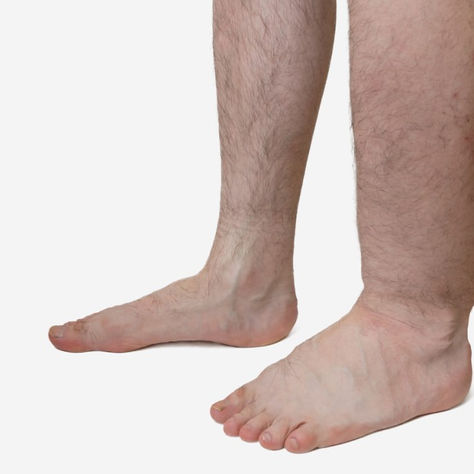 Linfedema y drenaje linfático manual