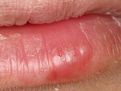 Laser Treatment for Cold Sores