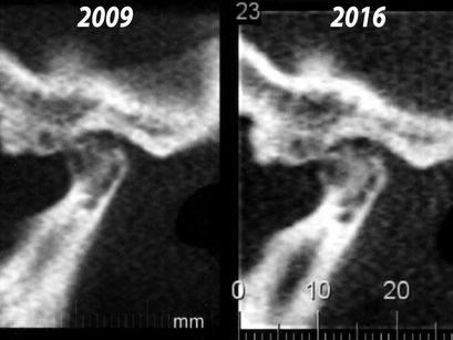 Rheumatoid Arthritis Improvement after TMJ Treatment