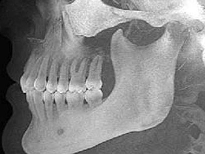 Condylar Remodeling in a Rheumatoid Arthritis Case 7 Years Later