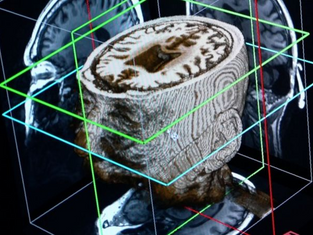 Ученые: искусственный интеллект сможет диагностировать деменцию за один день