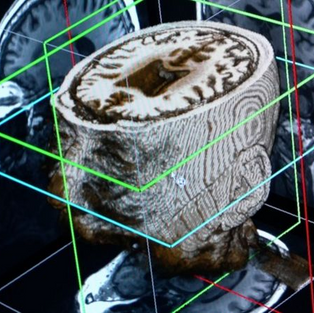 Ученые: искусственный интеллект сможет диагностировать деменцию за один день