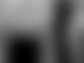 人工股関節手術の進歩