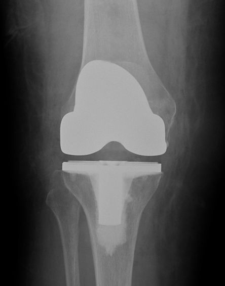 Primary Total Knee Replacement - Revolution Orthopaedics