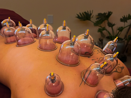 Cupping applied for myofasical release to release back pain in southwest, fl