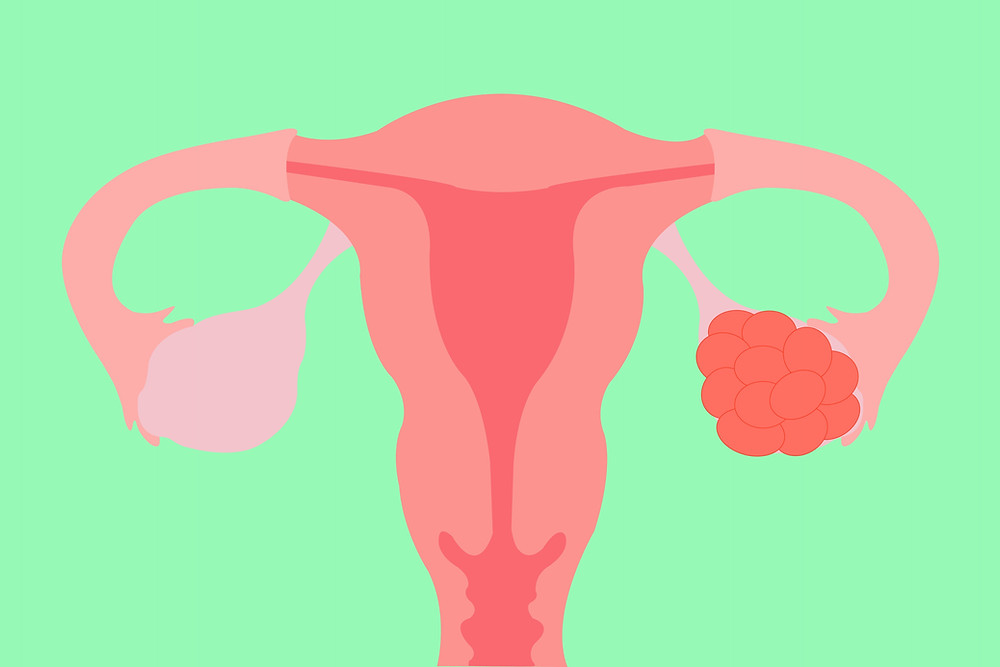 Image of a uterus and ovaries with
