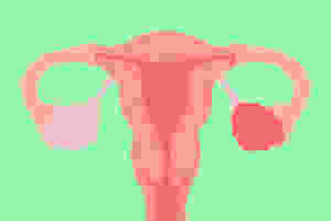Image of a uterus and ovaries with