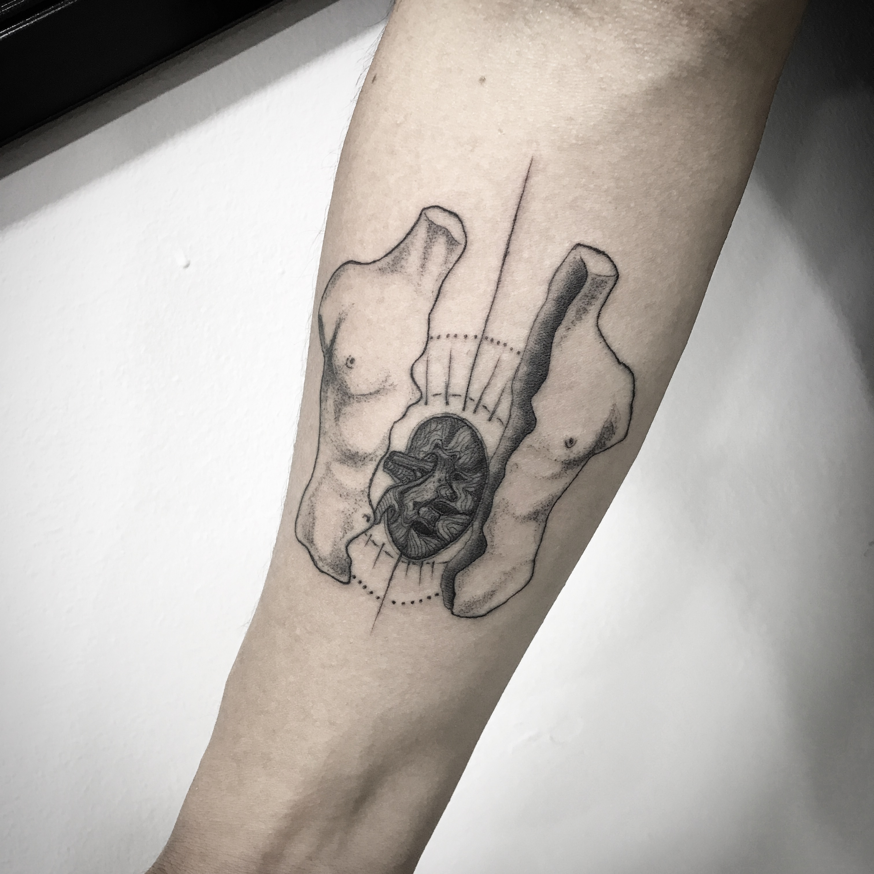 Kidney Transplant