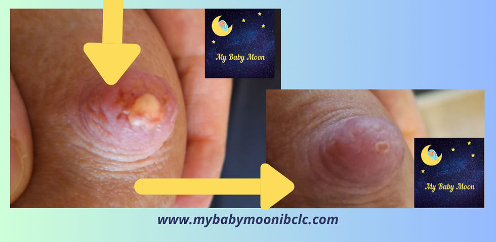 ampoule du mamelon téterelle trop petite