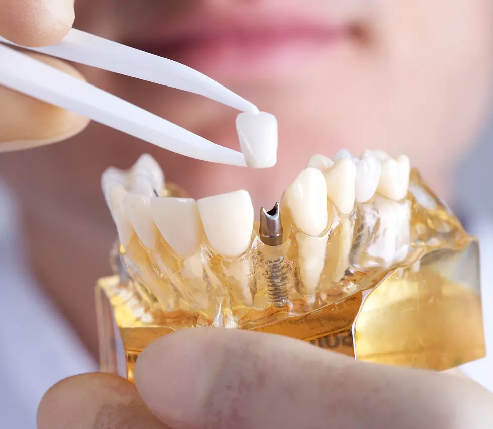 Why-choose-Columbus-Dental-Smile-for-dental-implants-3