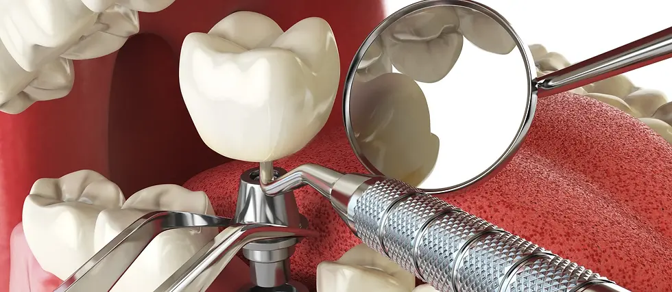 Benefits-of-dental-implants-scaled.webp