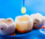 Why-choose-Us-for-dental-fillings-sealants-in-Columbus-IN-1