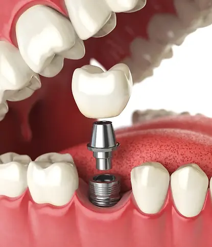 Dental-implants-in-Columbus-IN-1.webp