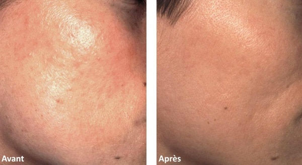 acne.jpeg
