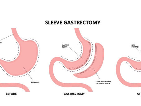 ¿Cuánto dura una Manga Gástrica?