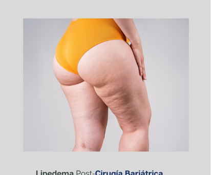 LIPEDEMA POST CIRUGÍA BARIÁTRICA UN DESAFíO RENOVADO