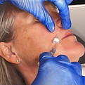 alt="Client receiving lip filler treatment at Esthetics UK in Whitton"