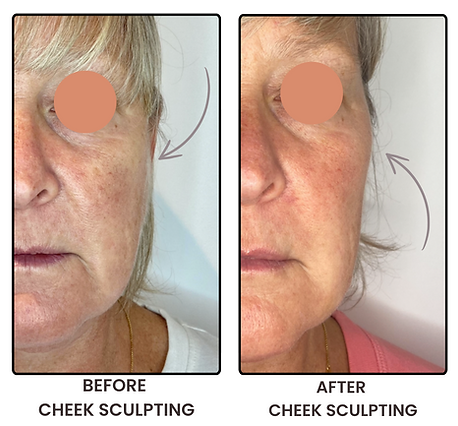 alt="Client receiving cheek filler treatment at Esthetics UK in surrey and middlesex"